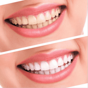 White Bright - Now Teeth Whitening Changes Forever
